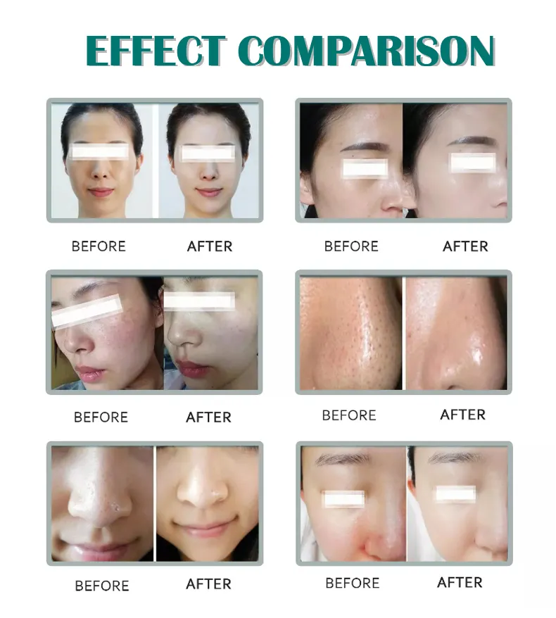 Fractional RF Microneedle Acne Treatment Facial Portable Beauty Machine