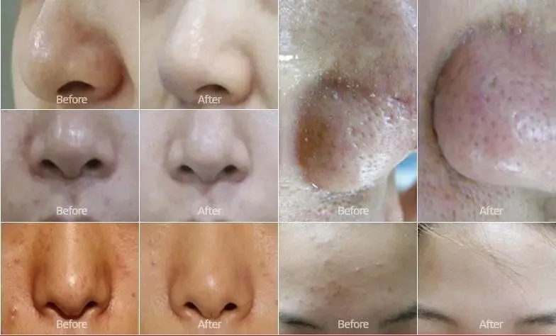 Professional Hydro Peel Water Dermabrasion Facial Beauty Machine with Bio Ultrasound RF