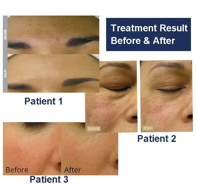 Application of Hydro Treatment