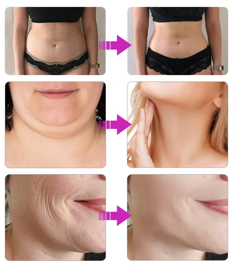 Best 2 in 1 Fat Freezing and Thermal Shock EMS Body Slimming and Facial Machine