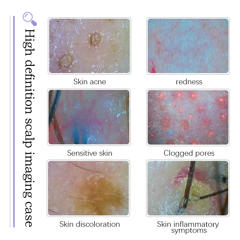 Hydro dermabrasion Feature 5