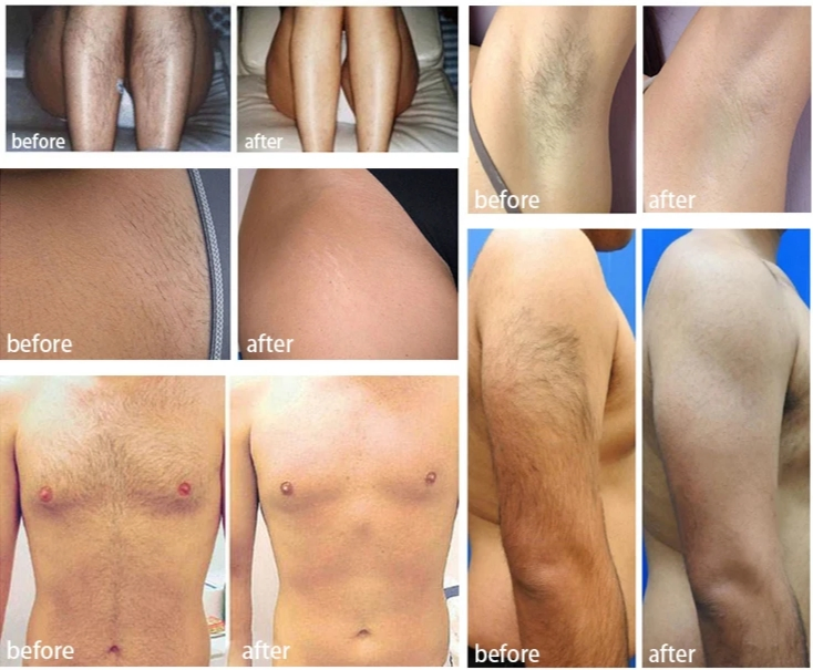 Professional Android System 808 Diode Laser Machine &amp; Hair Analysis for All Skin Types
