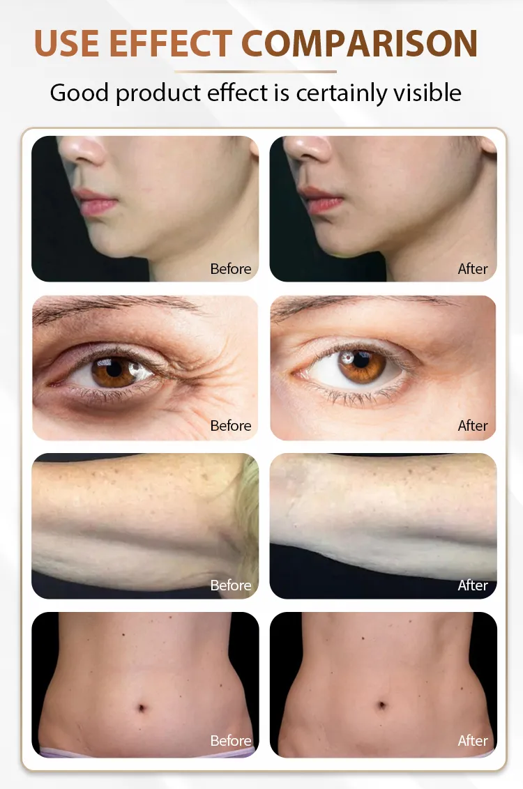 Microfocus Ultrasound Technology Facial Lifting Body Care Skin Tightening Whitening Machine
