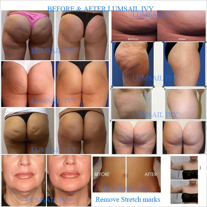 Cellulite Reduction mechanism of Action