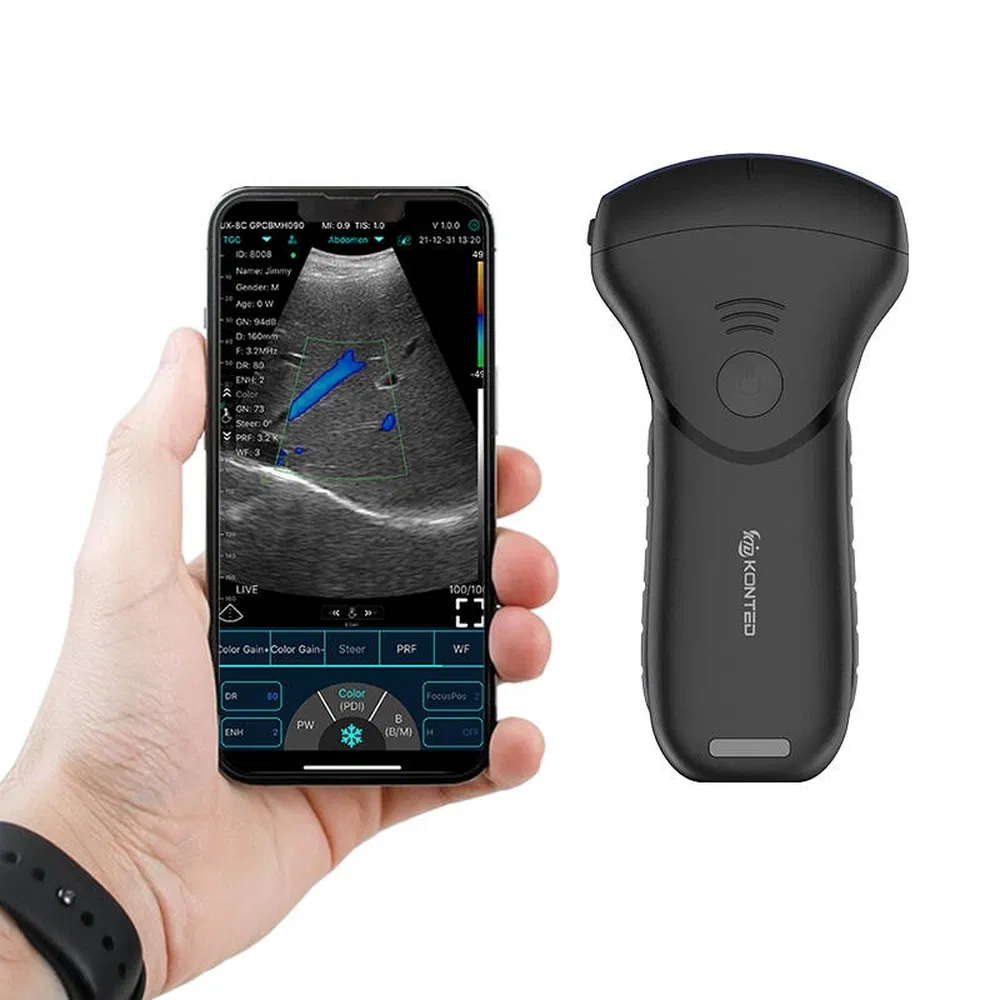 Handheld Precision Multi-Platform Ultrasound System Probe for Kidney and Lung Analysis