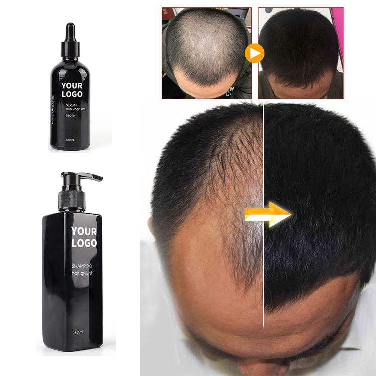 Wholesale Organic Ginger Onion Castor Rosemary African Fast Hair Growth Oil For Black Women Private Label