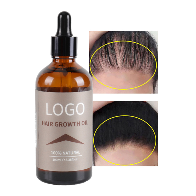 Wholesale Organic Ginger Onion Castor Rosemary African Fast Hair Growth Oil For Black Women Private Label