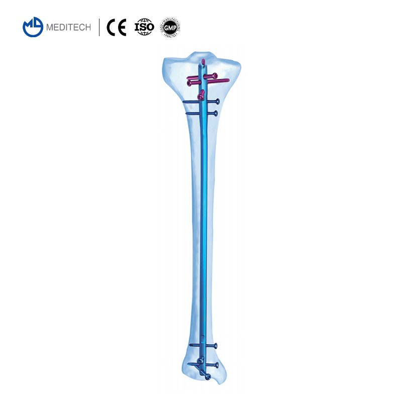 Direct Sale Orthopedic Implant Titanium Expert Tibia Interlocking Intramedullary Nail
