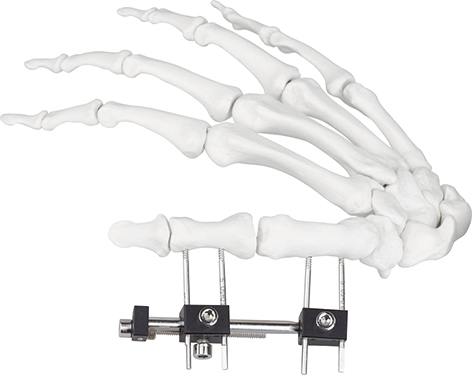 External Fixator Hand Bone Pin Stent Radius Mini Fixator Universal Compression Extension Type