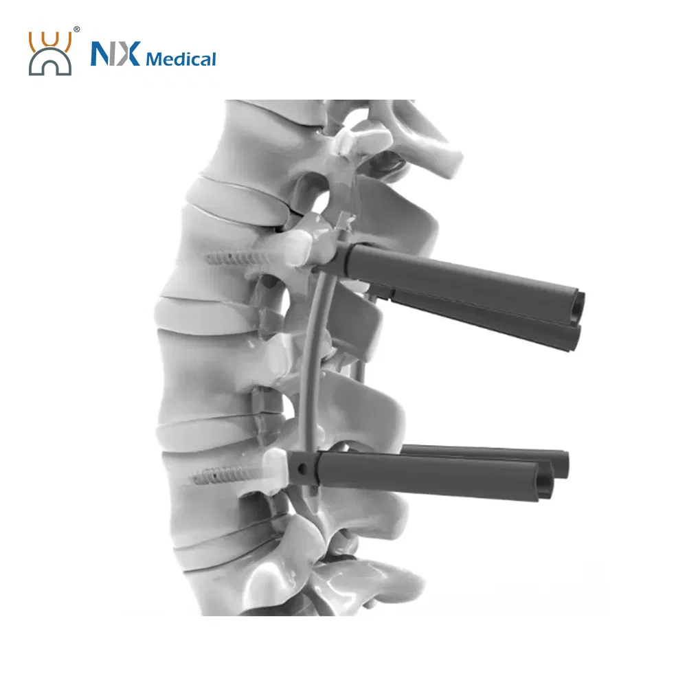 Nx Medical Titanium Cannulated Bone Cement Pedicle Screw Orthopedic Internal Fixation