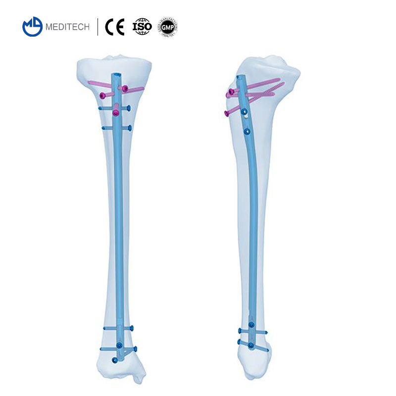 Direct Sale Orthopedic Implant Titanium Expert Tibia Interlocking Intramedullary Nail