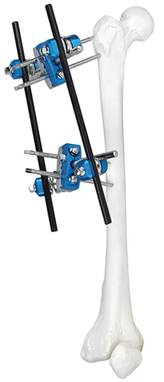 Proximal Femur Fixator