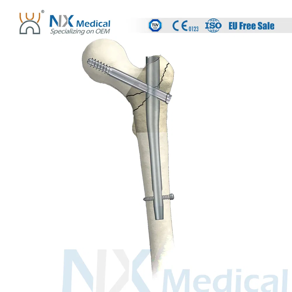 Nx Medical Orthopedic Trauma Titanium Intramedullary Interlocking Femoral Femur Pfna Bone Nail