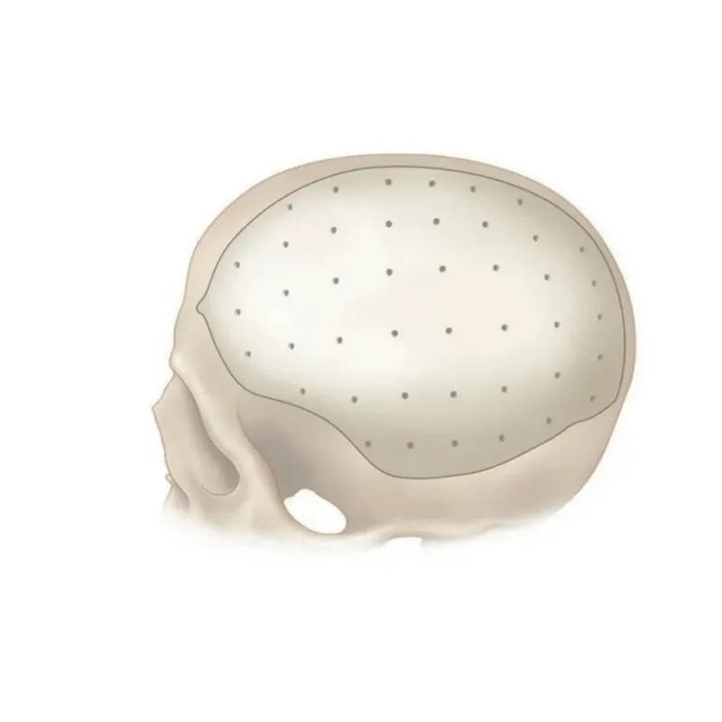 Neurosurgery Peek Patient Specific Implant Custom Maxillofacial Repair System