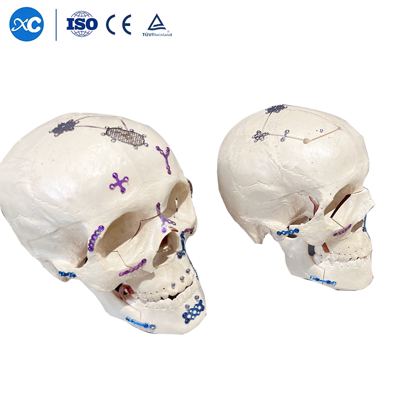 Orthopedic Micro Surgical Implants Maxillofacial Titanium Plate Implant