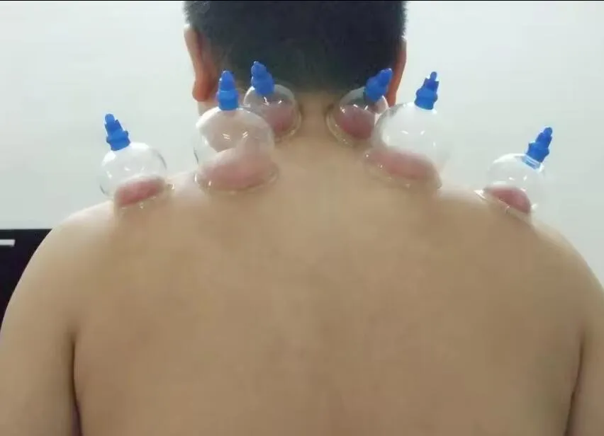 Cupping Therapy 2