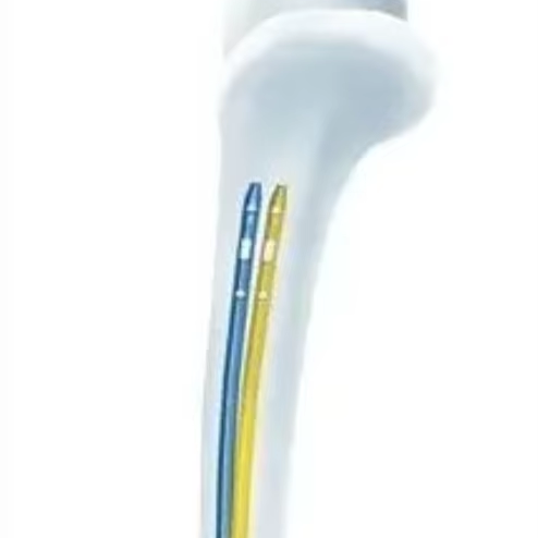Surgical Instruments Orthopedic Implants  PFNA Bone Femoral Nail Titanium Locking Intramedullary Nails