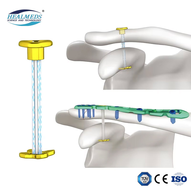 Innovative Double Loop Fixation Button for Knee Ligament Reconstruction ACL PCL Implants Surgical Interventional Materials