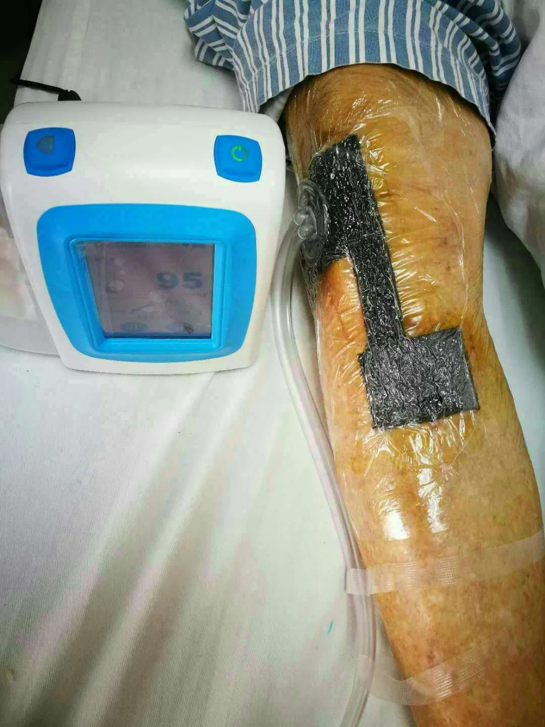 Portable Surgical Negative Pressure Wound Therapy Systems