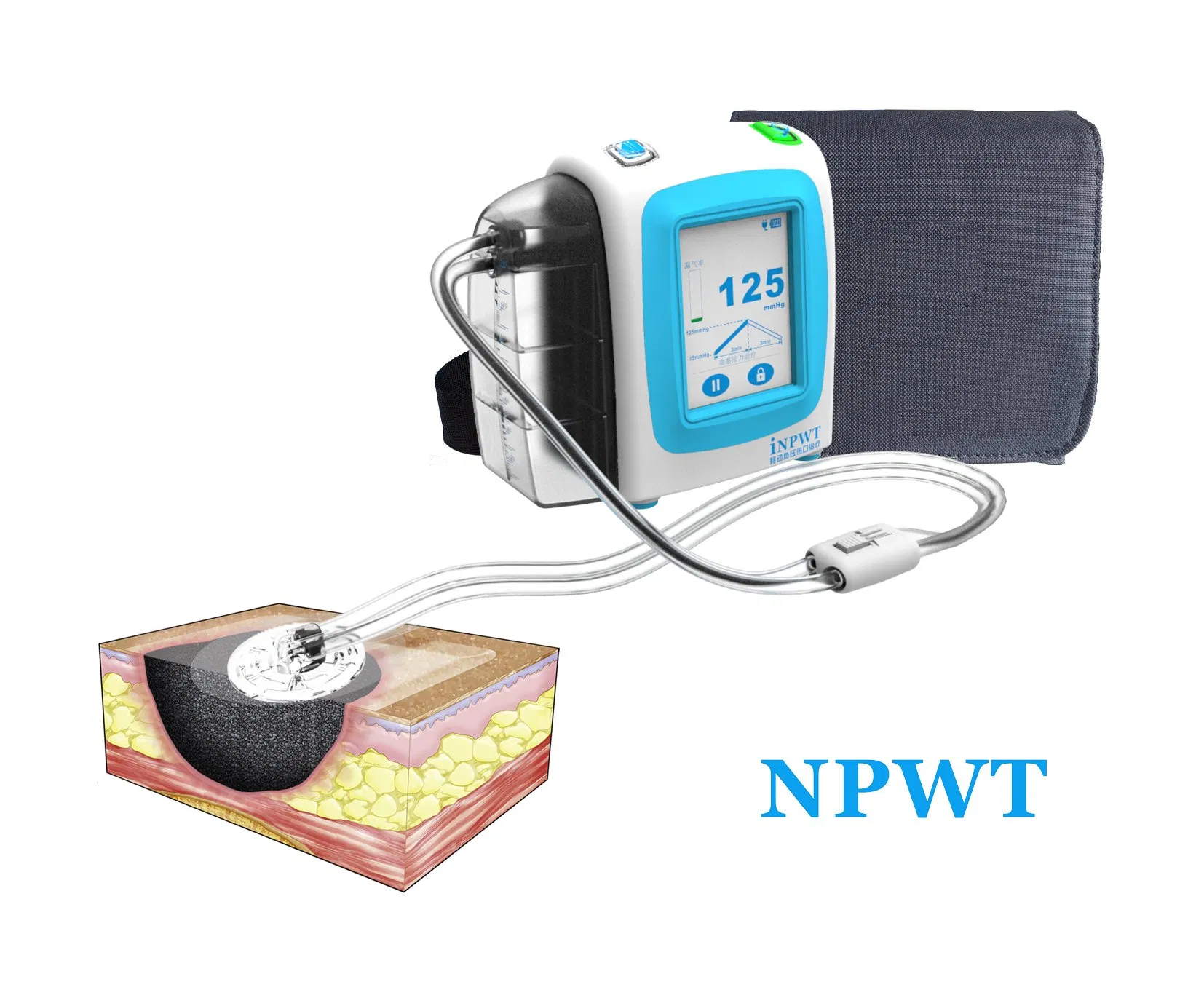 Portable Surgical Negative Pressure Wound Therapy Systems
