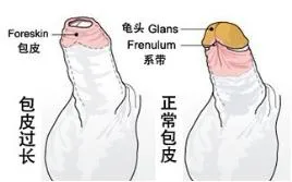 Foreskin vs Normal Comparison