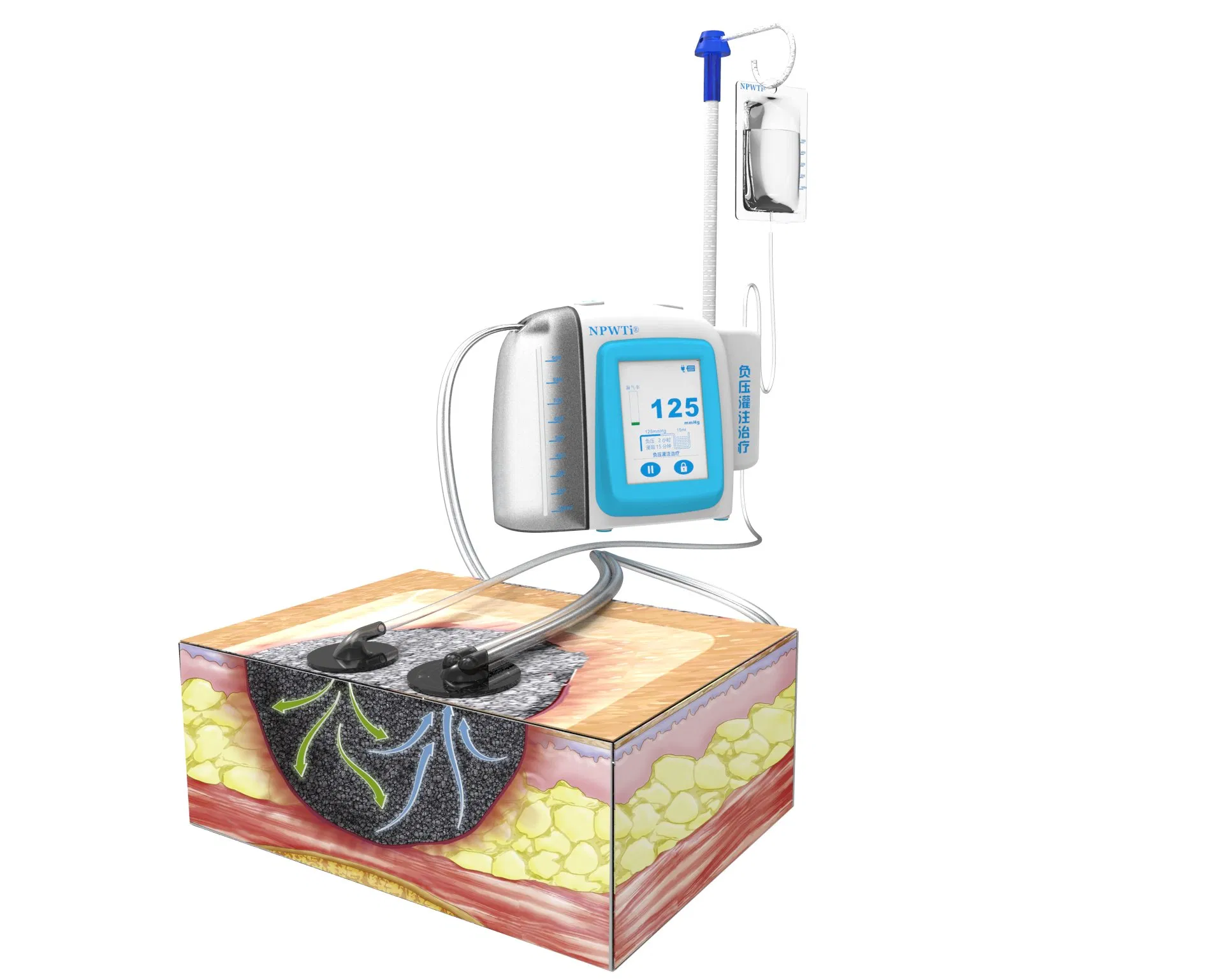 Portable Surgical Negative Pressure Wound Therapy Systems