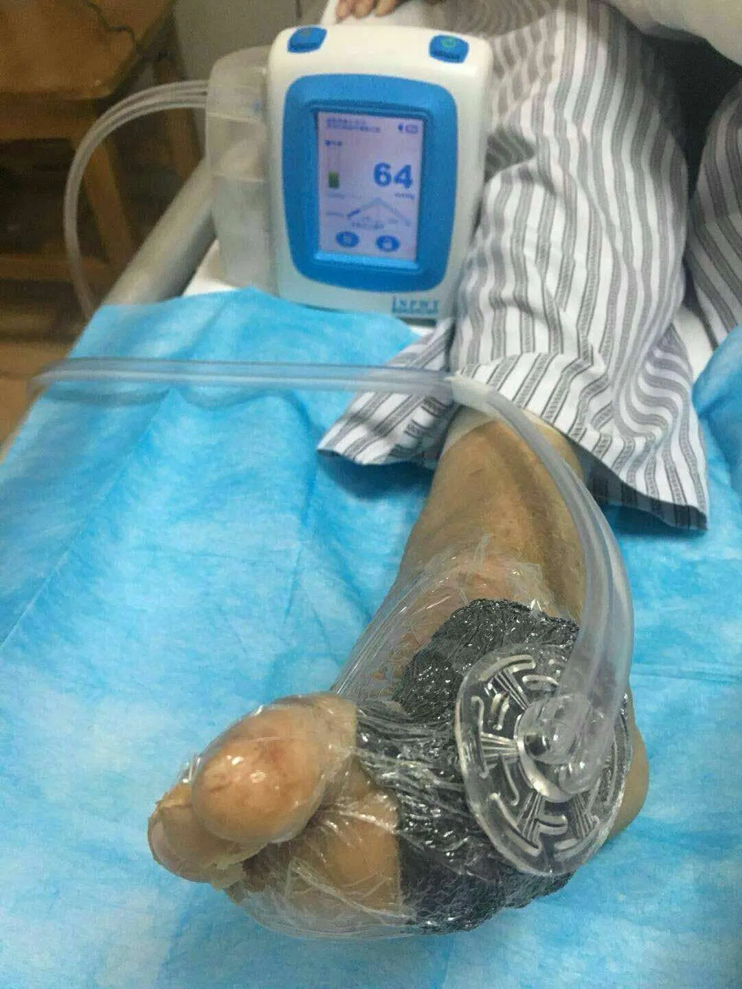 Portable Surgical Negative Pressure Wound Therapy Systems