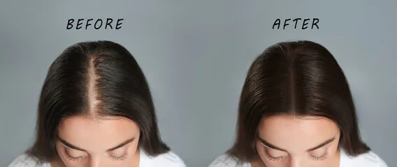 Hair Regrowth Laser Device Treatments for Hair Loss