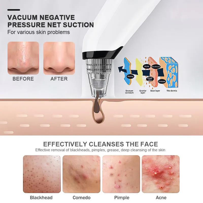 Blackhead Remover 7