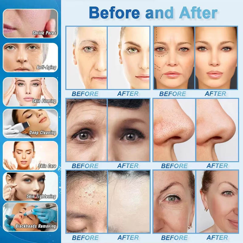 Promotion 15in1 Skin Scrubber Face Cleaning Hydro Dermabrasion Hydra Beauty Facial Machine