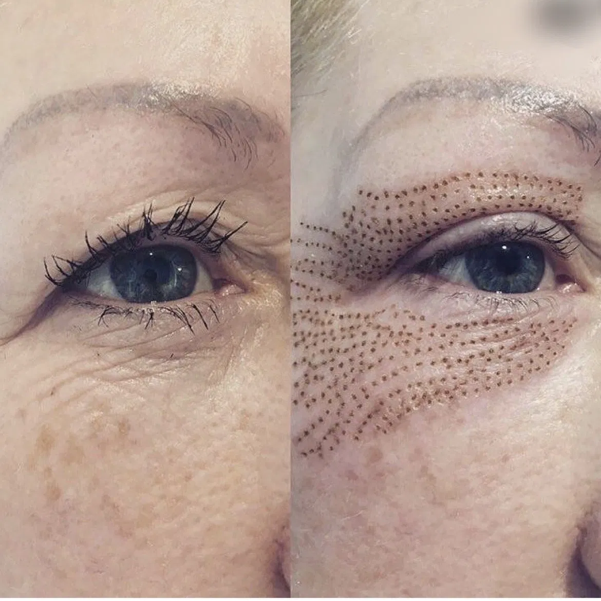 Cold and Warm Plasma Device for Effective Acne Treatment