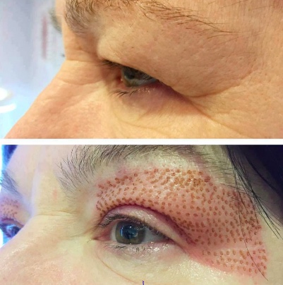 Cold and Warm Plasma Device for Effective Acne Treatment