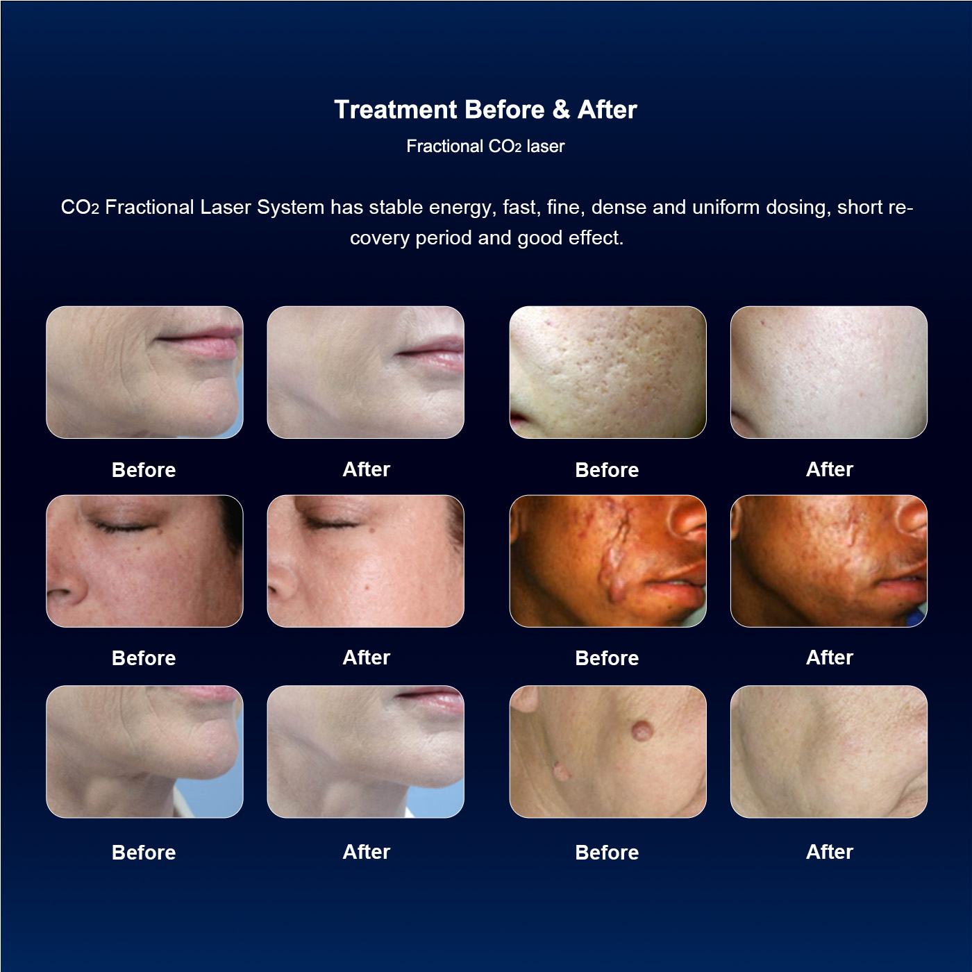 Skin Standing CO2 Fractional Laser Machine with RF Skin Resurfacing Vaginal Tightening Tattoo Removal 10600nm Wavelength