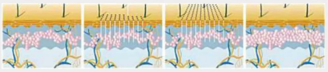 Laser Treatment Principle