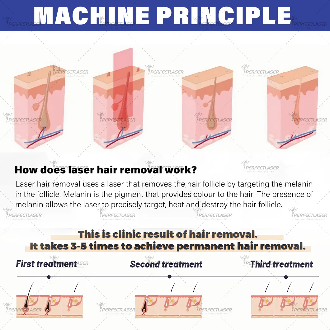 Painless Permanent 755nm 808nm 940nm 1064nm Machine Power 7500W Inflammatory Acne Treatment OEM ODM Factory Diode Laser Hair Removal Device