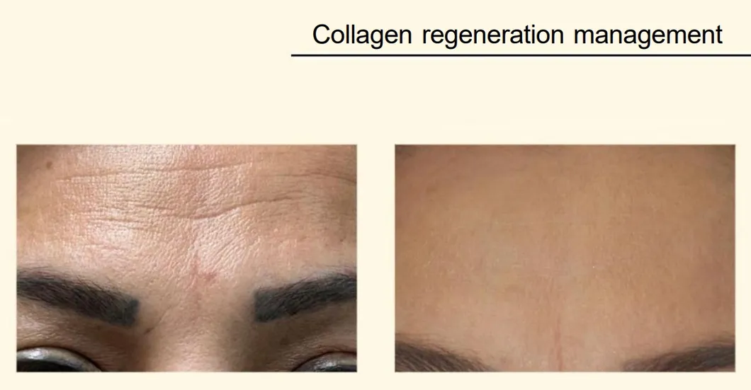 Jet Plasma Technology Anti-Aging Skin Care Collagen Regeneration Surgical Device Cold Plasma