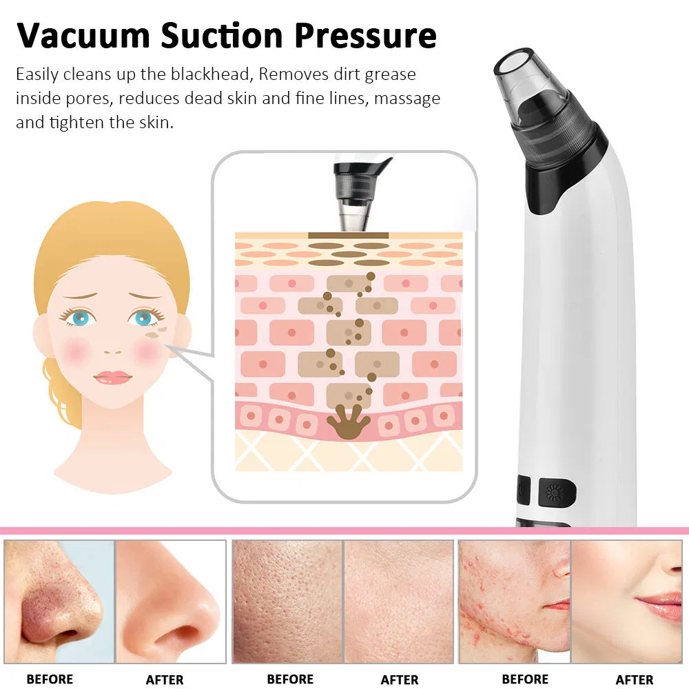 Blackhead Remover 11