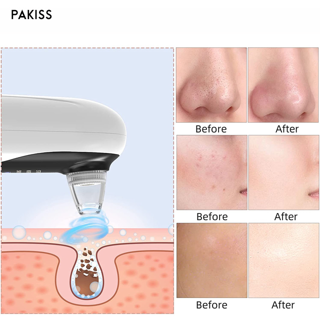 Pakiss Electric Blackhead Remover, Painless Pore Vacuum for Deep Skin Cleaning