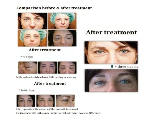 New 2 in 1 Plasma Picosecond Laser Device for Acne Removal Skin Elasticity and Dark Spot Pigment Treatment