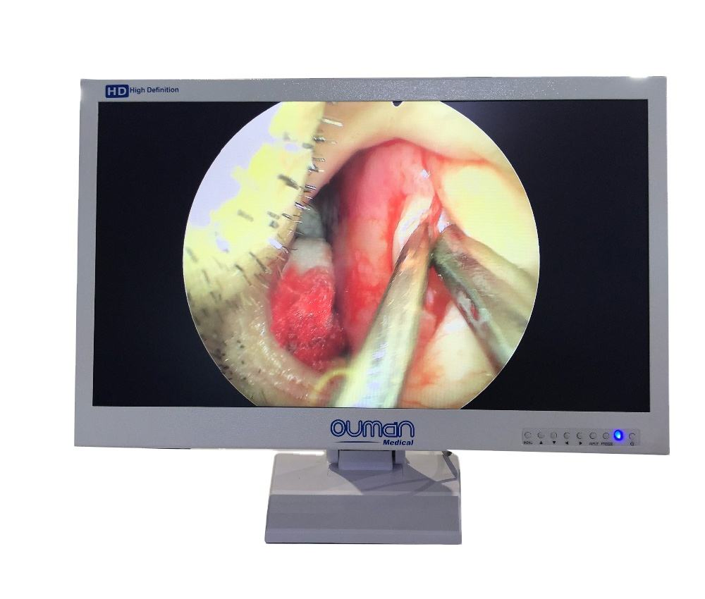 Ouman Endoscopy Camera System with Om-2410HD Medical Grade LCD Monitor