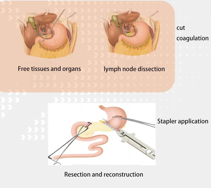 Scalpel System 7