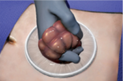 Wound Retractor Step 5