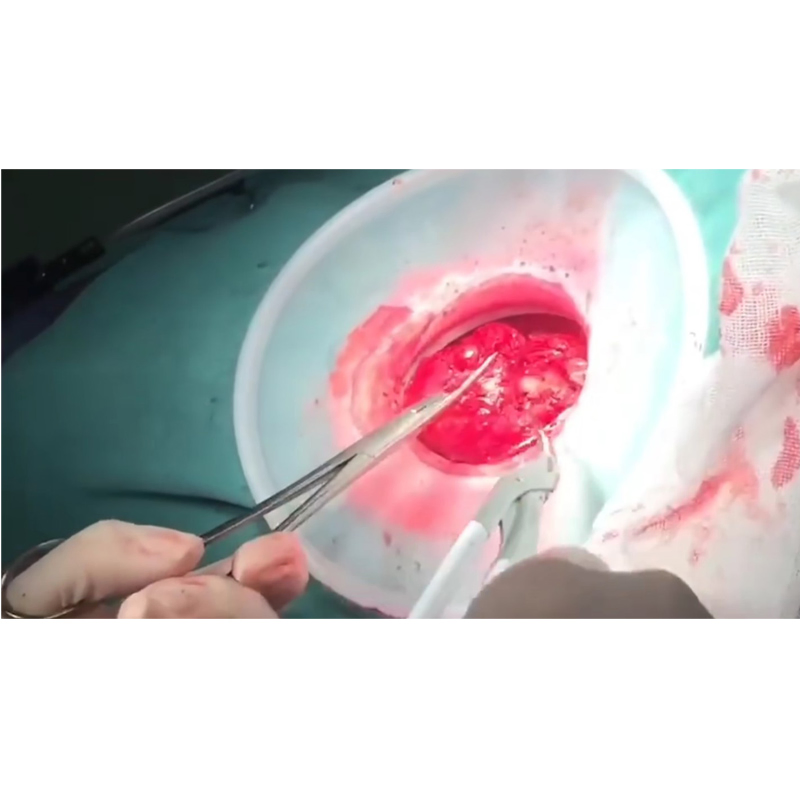 Disposable Incision Protection Sleeve Wound Protectors/Retractors