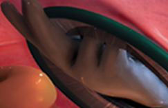 Wound Retractor Step 3