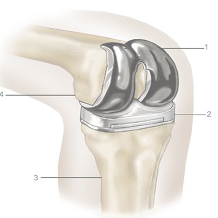 Replacement of Artificial Total Prothesis Knee Prosthesis