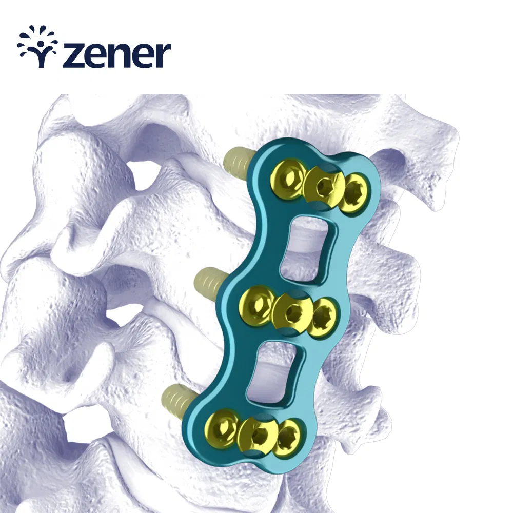Medical Instrument Laminoplasty Intervertebral Fusion Cage System Spinal Implant Mercury Anterior Cervical Plate (Titanium)