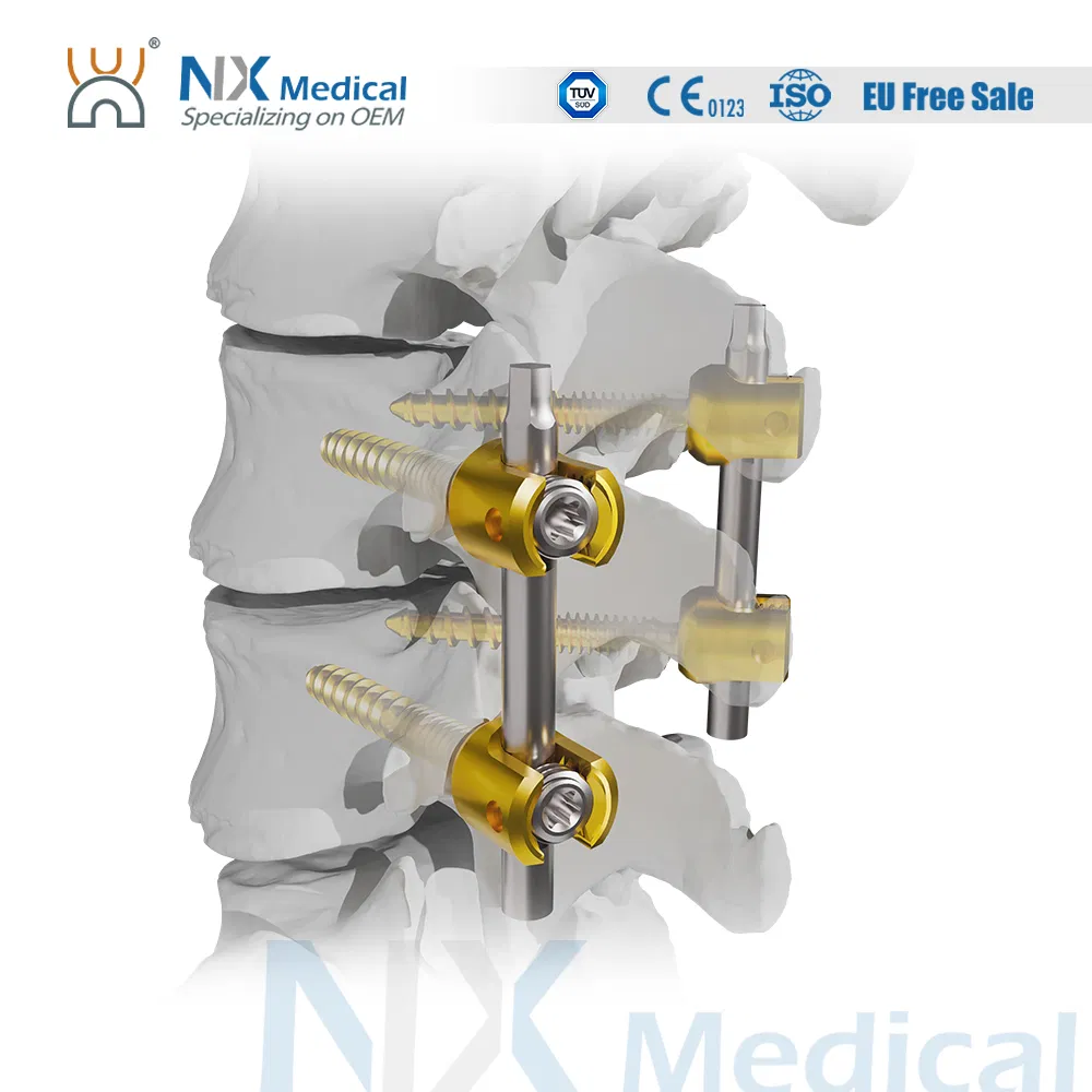 Nx Medical High-Quality Sf-I &amp; Sf-II Spinal Pedicle Screw 6.0mm for Bone Fixation