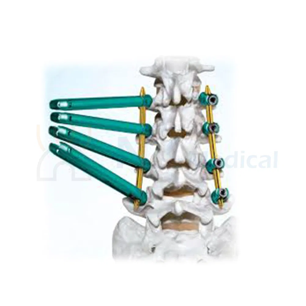 Nx Medical Spine Implant Spinal Pedicle Screw 5.5mm System Titanium OEM ODM for Fixation