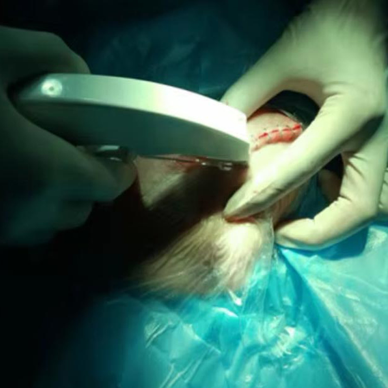 Flexible and Convenient Disposable Single Use Disposable Skin Stapler Skin Staple Remover