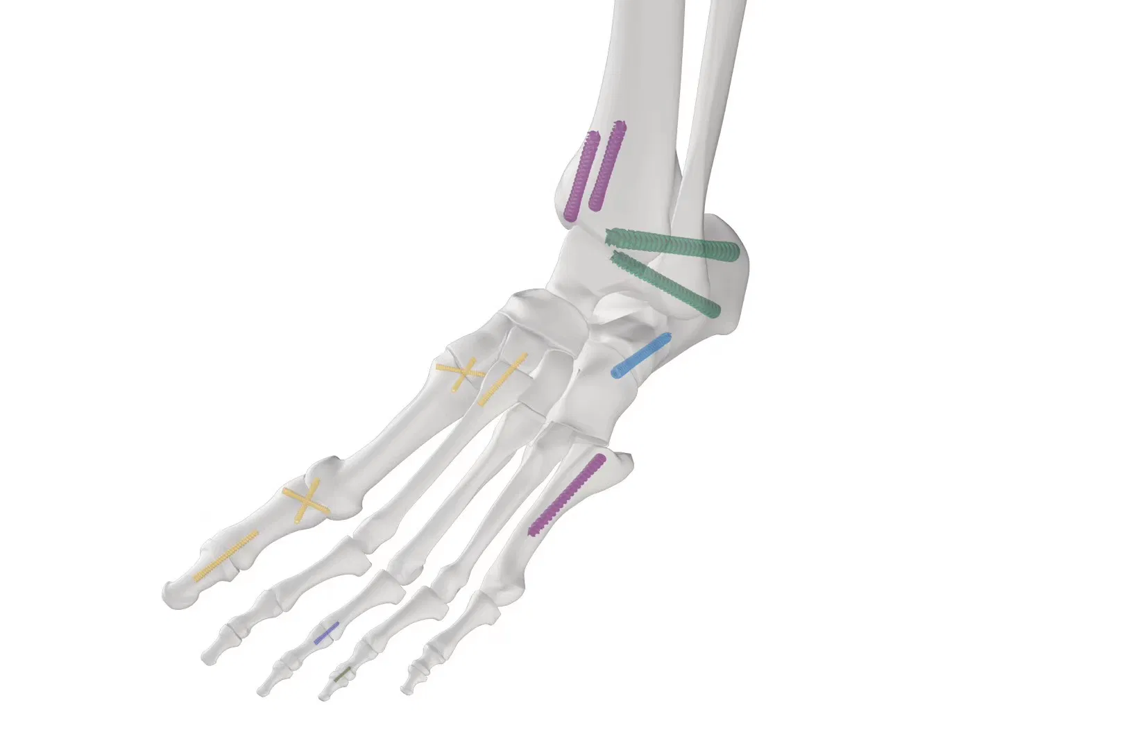 Headless Cannulated Compression Screw, Titanium Orthopedic Locking Screw Implant Medical Mini Bone